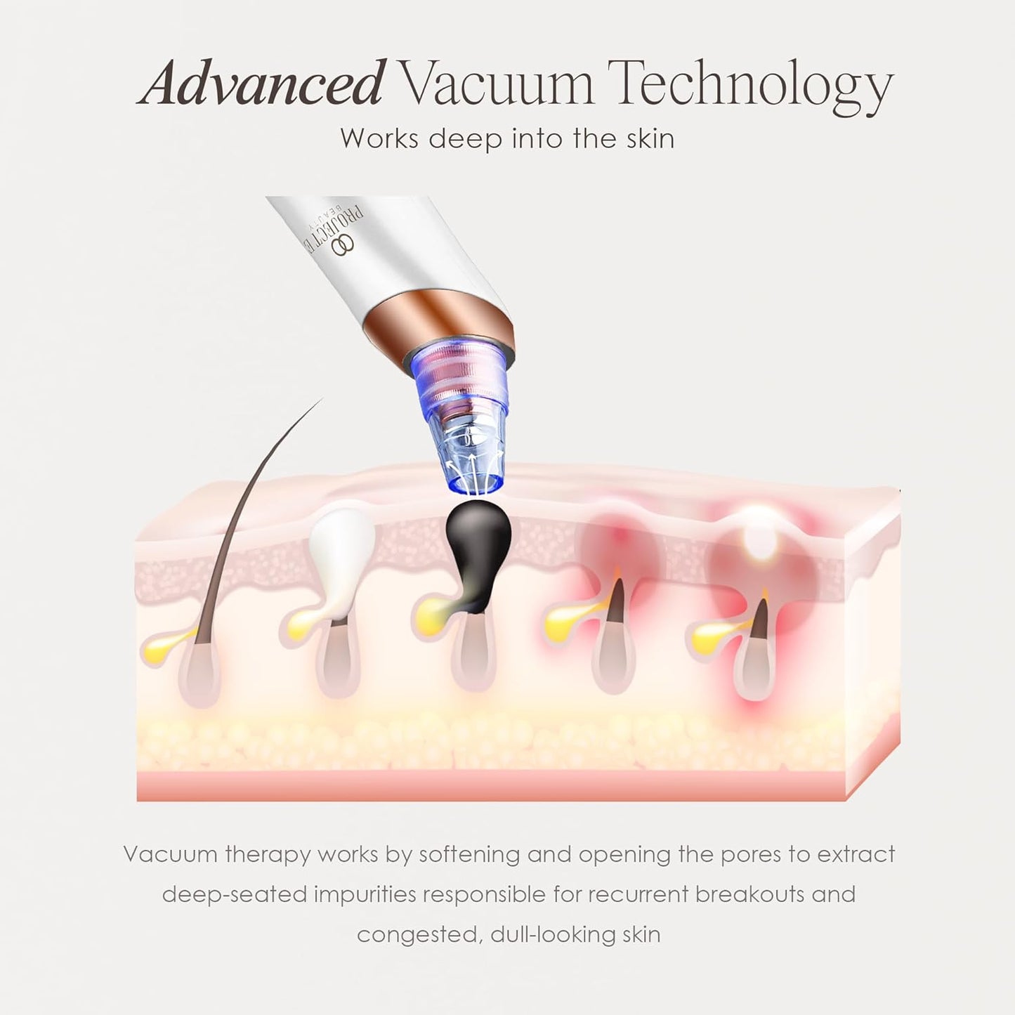 Project E Beauty Blackhead Removal Pore Vacuum | Blackheads & Whiteheads Extractor | Pore Cleansing | Strong Suction | Minimized Pores | Tighter, Firmer Skin | with 5 Suction Heads